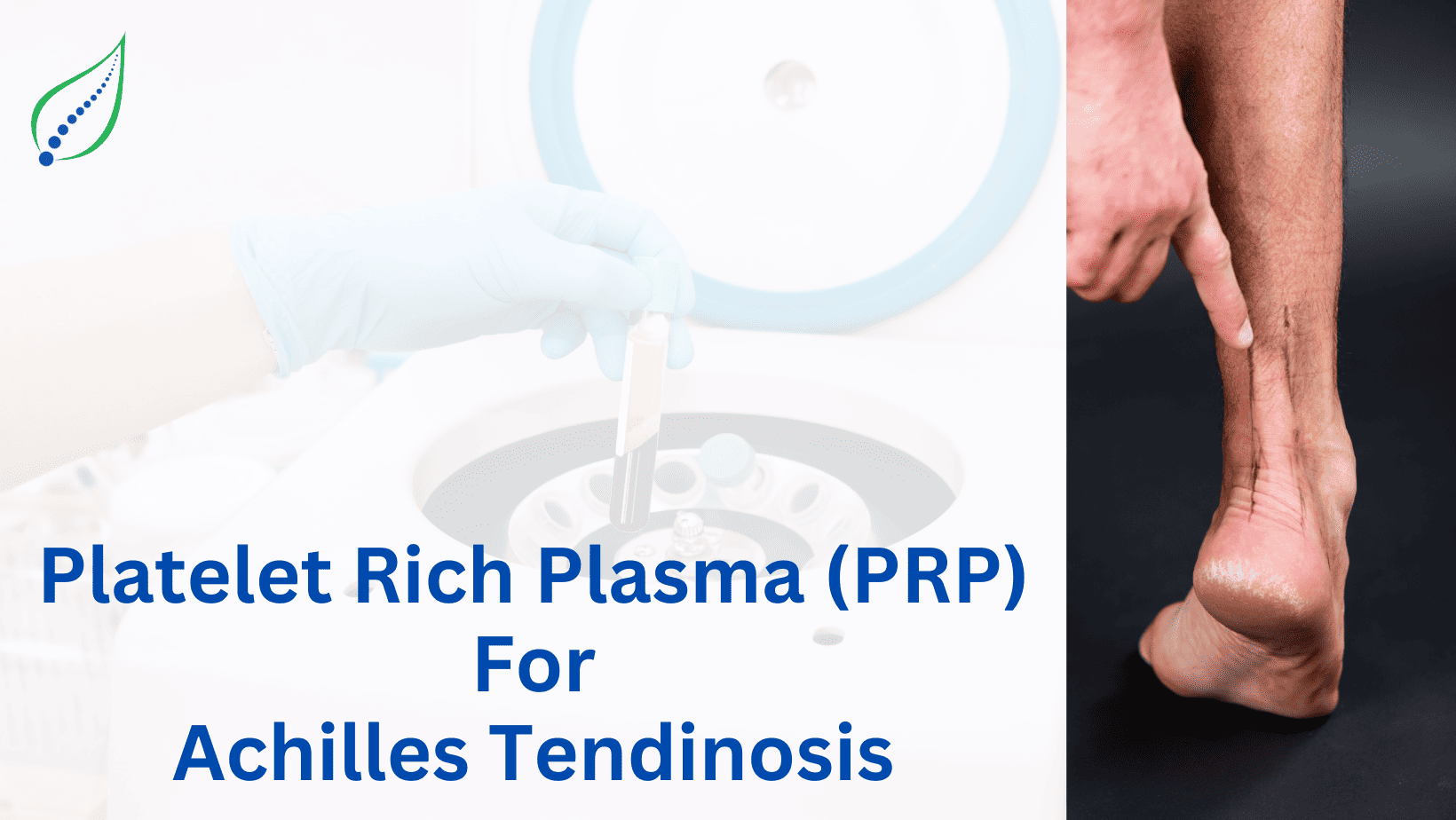 PRP For Achilles Tendinosis